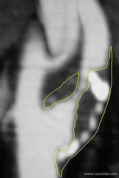 1221 angioscanner stenose carotidienne plaque