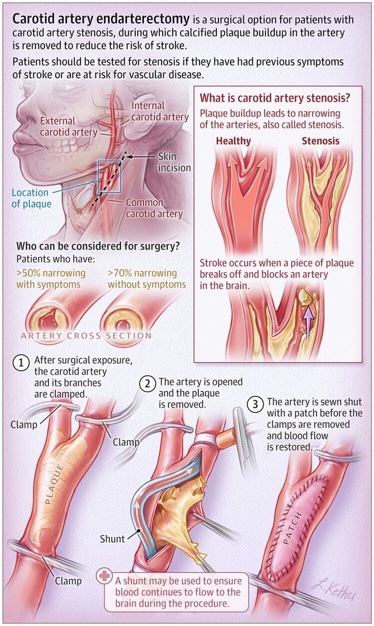Endartérectomie carotidienne