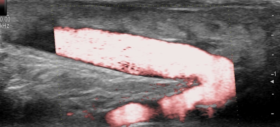 FAVRADIALE