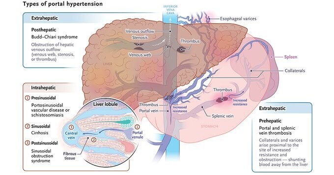 Hypertension portale