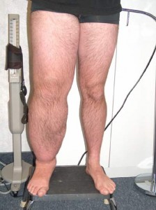 Info Patient : œdème des MI 