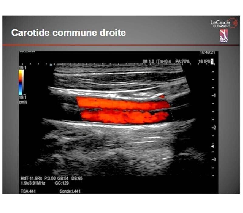 Dossier : dissections des artères cervicales (Partie 2) 