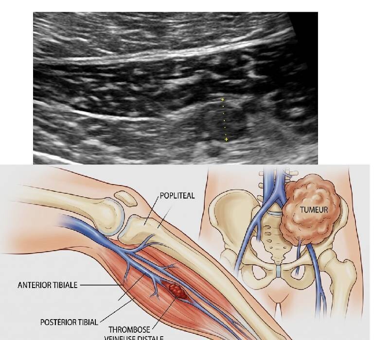 TVP distale et Cancer 