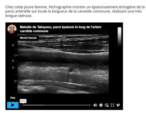 Dossier TAKAYASU avec le Pr Ahmed Hatri