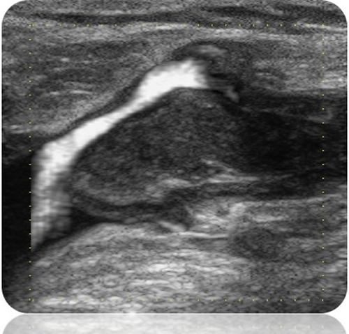 VFCETTHROMBUS