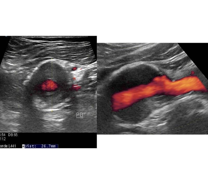 Anevrisme artère poplitée : nouvelle donne 