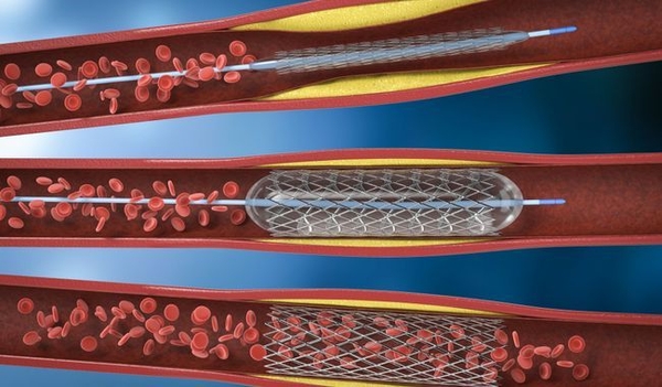 angioplastie convalescence stent deroulement risques