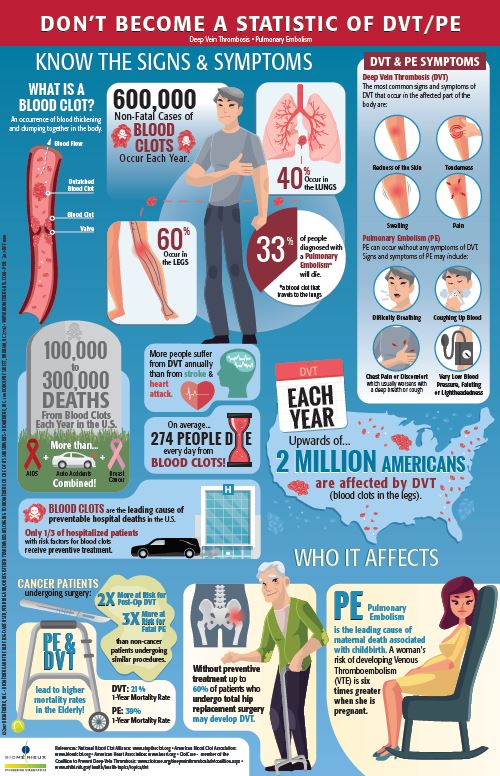 dvt infographic image