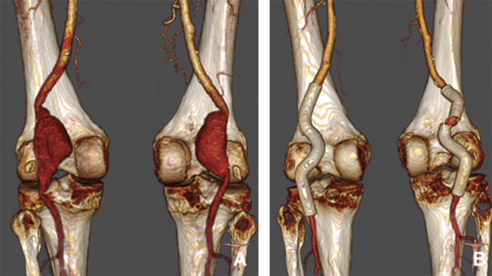 endo couverte