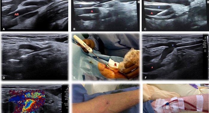 Figure 3. Étapes réelles de création d’une FAV percutanée avec le système Ellipsys® chez un patient de 66 ans. A. Visualisation en coupe échographique longitudinale de la veine céphalique (VC) et de l’artère radiale proximale (AR). B. Ponction échoguidée par aiguille 21 G de la veine céphalique puis navigation dans la veine céphalique médiane jusqu’à la veine perforante. C. Ponction directe de l’artère radiale proximale à travers la veine perforante du coude. D et E. Mise en place sur microguide du cathéter Ellipsys® en position ouverte, qui vient buter contre la paroi artérielle lors de sa traction. F. Après l’activation du générateur, l’application de l’énergie thermique permet la création d’une anastomose permanente par thermofusion, visible sous forme d’une communication entre la veine (V) et l’artère (A) avec aliasing en mode Doppler couleur (G). La veine céphalique est bien visible en fin de procédure et discrètement dilatée (H), permettant la ponction pour hémodialyse à 1 mois (I).