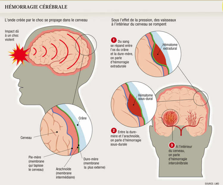hemorragie cereb infog ng responsive half