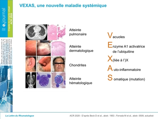 Entretien avec Nicolas Gendron : Syndrome VEXAS
