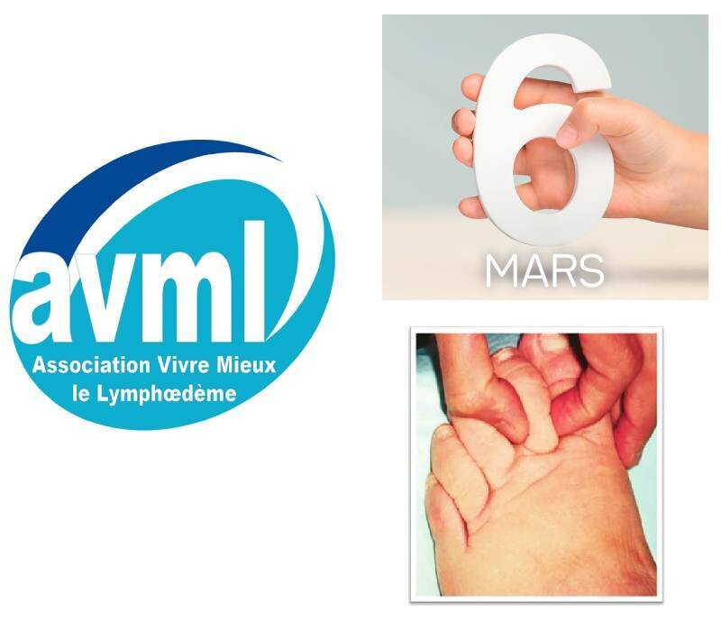 Journée Mondiale du Lymphoedème : 6 Mars 2026