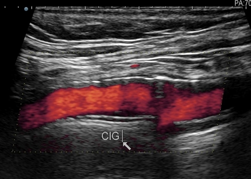 stent C int