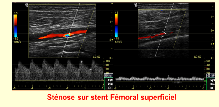 stent FSUPSTENOSE
